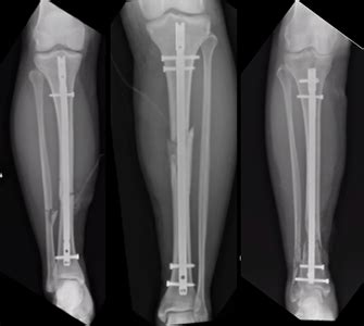 Tibia compression fracture treatment - lopiren