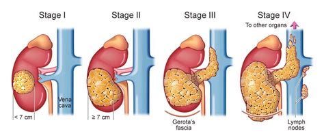 Best Kidney Cancer Treatment In Pathankot | Best Prostate Cancer ...