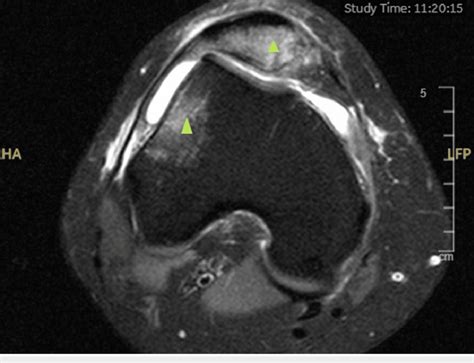 Axial T2-weighted MRI of the right knee showing the classical bone ...