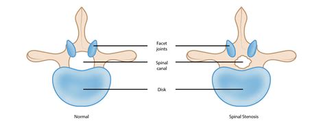 Lumbar Spinal Stenosis - OrthoInfo - AAOS