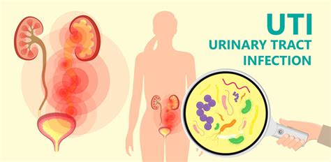 Urinary Tract Infections: Symptoms And Complications, 60% OFF