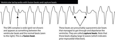 Ventricular Tachycardia Vt Ecg Criteria Causes Classification