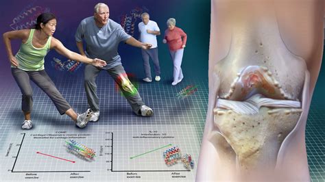 Osteoarthritis Knee Swelling