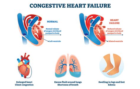 Congestive Heart Failure (CHF) symptoms, causes, treatment, medicine ...