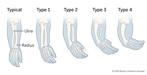 Radial Longitudinal Deficiency (Radial Club Hand) | Boston Children's ...