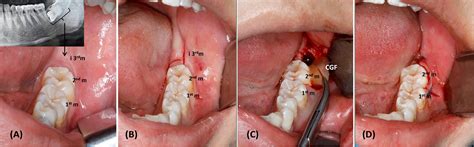 Alveolar Socket