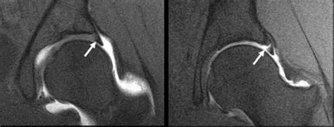 MRI and Hip Labral Tear - Robert Howells