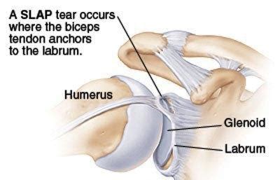 Shoulder Labral Tear- Relevant Anatomy and Function: Ashvin K. Dewan ...