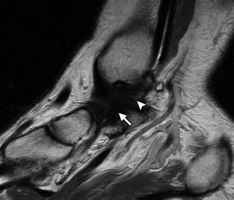 Torn Deltoid Ligament