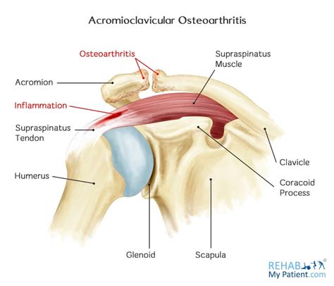 Acromioclavicular Osteoarthritis | Rehab My Patient