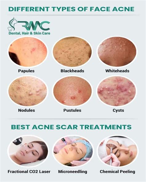 Acne Scars: Types, Causes and Treatment in Islamabad