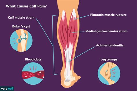 Leg Pain Calf Muscle