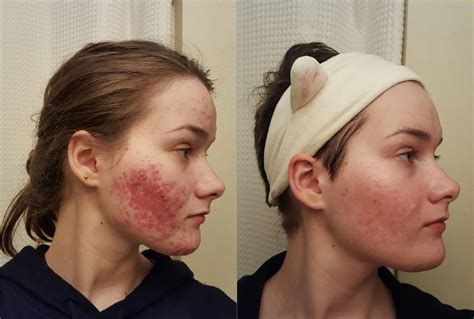 acne before and after reddit