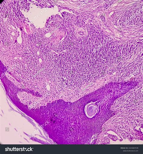 Dermatofibroma Histology