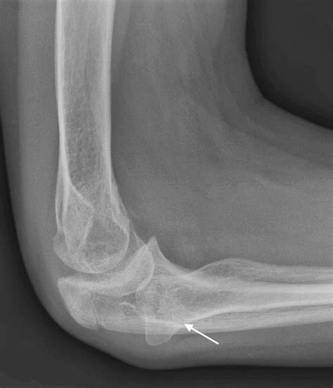 Congenital Dislocation of Radial Head | Bone and Spine