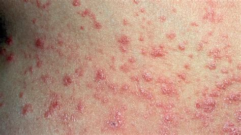 Is That Rash Psoriasis? Psoriasis Pictures and More | Everyday Health