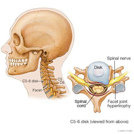 Facet arthritis - Overview - Mayo Clinic Orthopedics & Sports Medicine