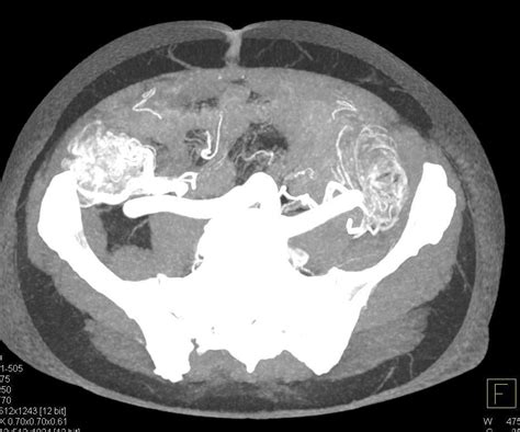 Angiodysplasia Cecum and Ascending Colon / CTisus.com | Case study ...