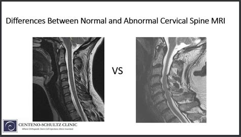 Mri Images Spine