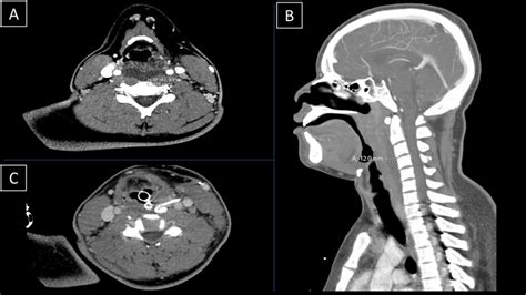 CT Angiogram Head and Neck with and without contrast on 7/21 compared ...