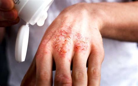 The Miracle Trick to Relieve Eczema | Reader's Digest