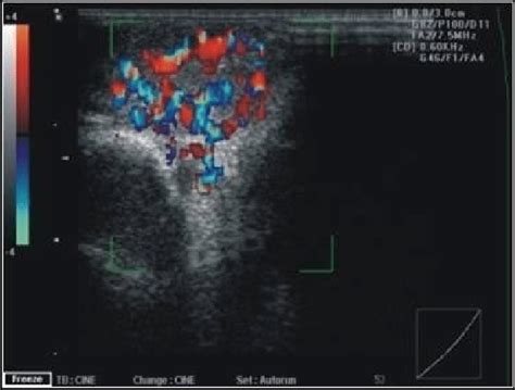 An ultrasound color Doppler image of a hemangioma. | Download ...