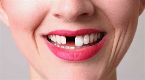 What Can You Do About Missing Teeth ? Smile Denture and Implant Clinic