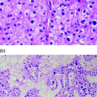 Chromophobe RCC and oncocytoma. (a) Chromophobe RCC, representative ...