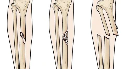 Tibia/Fibula Shaft Fracture - Carolina Regional Orthopedics