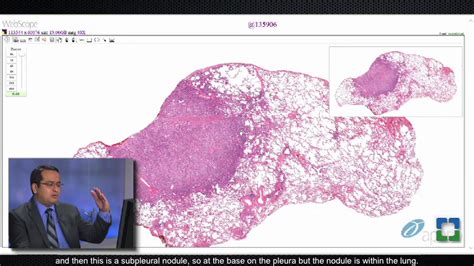 Lung Granulomas Caused by Fungal Infection - YouTube