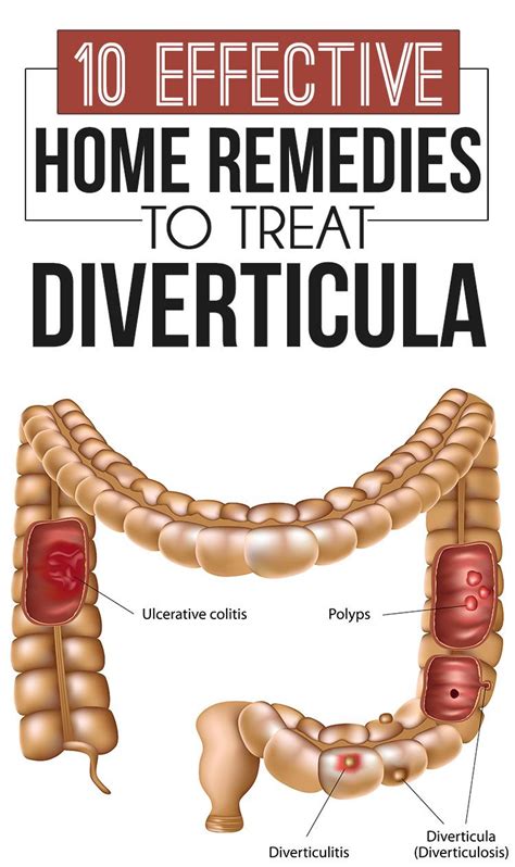 10 Effective Home Remedies To Treat Diverticula | Diverticulitis ...