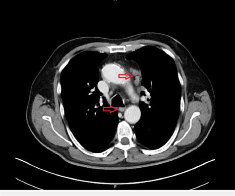 Mediastinal Lymph Nodes Lung Cancer