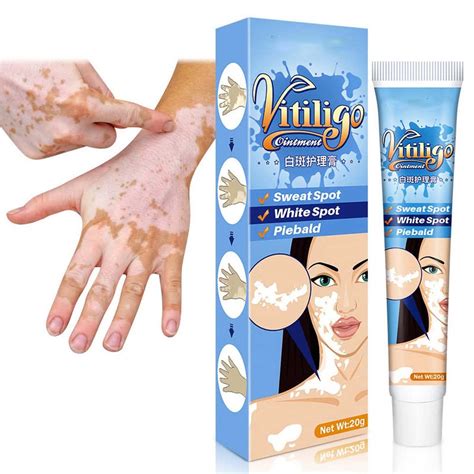 Buy Vitiligo Cream, Vitiligo , Vitiligo Care Cream, Vitiligo Cream for ...