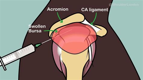 Subdeltoid Bursitis