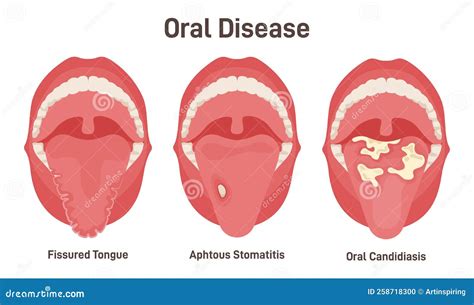 Tongue Problems Set. Fissured Tongue, Oral Candidiasis and Aphthous ...