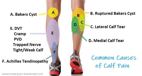 Calf Muscle Pain: Causes & Treatment - Knee Pain Explained