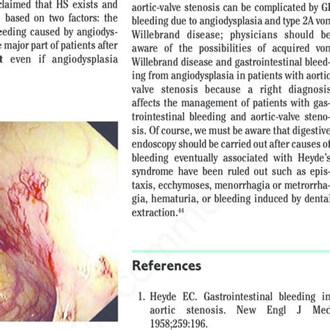 Colonoscopy showing bleeding due to angiodysplasia in the ascending ...