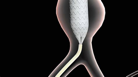 Abdominal Aortic Aneurysm Treatment Disease Technology Aortic Photo ...