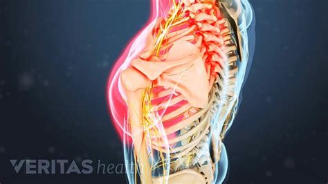 Cervical Herniated Disc Symptoms and Treatment Options