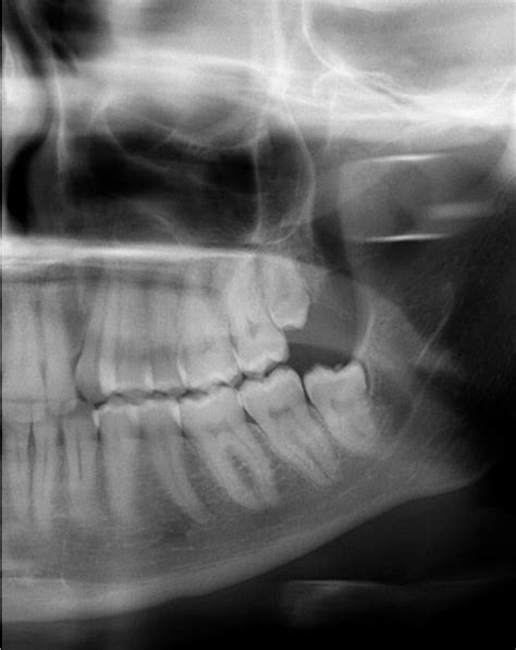 Wisdom Tooth Nerve Damage Risk? : r/Dentistry