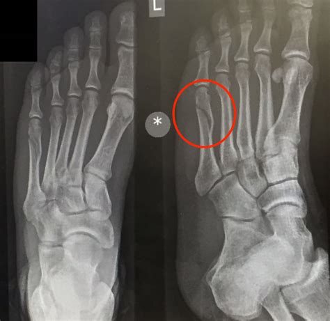 Breaking my 5th Metatarsal Bone - Spiral Fracture - KFFKR InsightsKFFKR ...