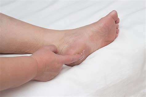 What Are Heel Spurs? | Causes & Treatments | Red Mountain Footcare