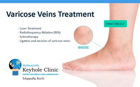 Varicose Veins Treatment in Kochi - Keyhole Clinic