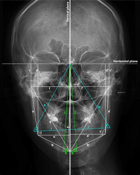 Reference planes used in the study: the horizontal plane, a line ...