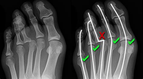 Gross Broken Bones X Ray