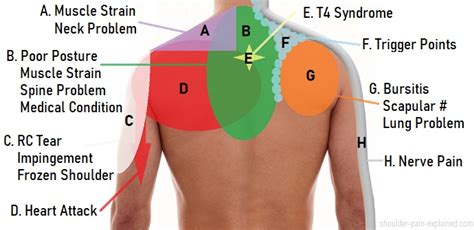 Shoulder Pain Diagram: Diagnosis Chart - Shoulder Pain Exp