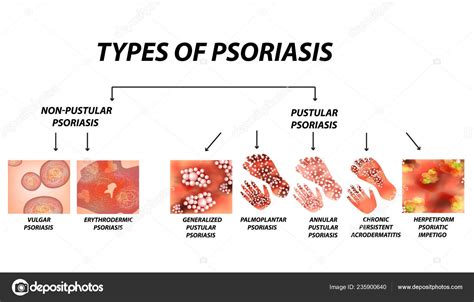 Vulgar Psoriasis Rash | ppgbbe.intranet.biologia.ufrj.br