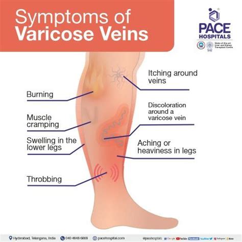 Varicose Veins Symptoms Causes And Natural Support Strategies | Hot Sex ...