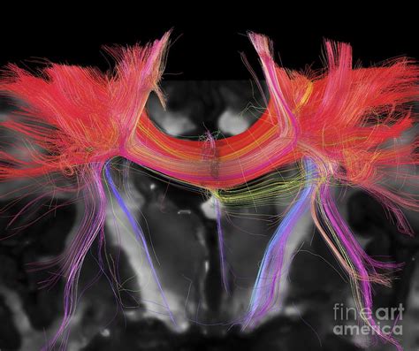 Corpus Callosum, Dti Mri Scan Photograph by Sherbrooke Connectivity ...