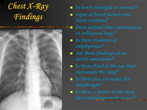 Chest X Ray Emphysema Findings